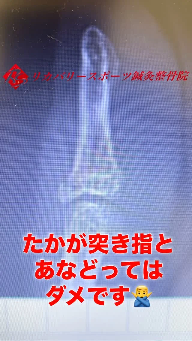 #突き指

たかが突き指だと侮ってはいけません！
突き指でも骨折を伴うことが、かなりの確率であります。
突き指をして、第1関節の手の甲側に痛みや腫れがある場合は、「マレットフィンガー」と呼ばれる骨折や腱の断裂を起こすことがあります。
骨折の場合で、転位が大きい場合には手術が必要なケースもあります。
ですので、たかが突き指と思わずに、一度当院にお越し下さい。
当院では、超音波画像観察装置で骨折の有無を確認し、骨折の疑いがある場合は、提携の整形外科を紹介します。
もし、骨折があった場合は、超音波骨折治療器をあてることで、骨の癒合を40%早めることができると言われていますので、早く治したい！試合までに間に合わせたい！方にはオススメです☝️

【受付時間】月・火・木・金　13:00〜21:00
　　　　　　土・日・祝　　　10:00〜17:00
【休診日】　水曜日

🏥尼崎市南武庫之荘2丁目7-10
☎️06-6415-6477

#マレットフィンガー
#骨折を早く治す
#ケガ
#痛み
#違和感
#尼崎
#南武庫之荘
#塚口
#ケガを早く治す
#ケガの治療
#骨折
#骨折治療器
#捻挫
#肉離れ
#超音波骨折治療器
#超音波画像観察装置
#テーピング
#競技復帰
#競技復帰までトータルサポート
#競技復帰までのトレーニング
#リアラインスペシャリスト
#土日祝日診療してます