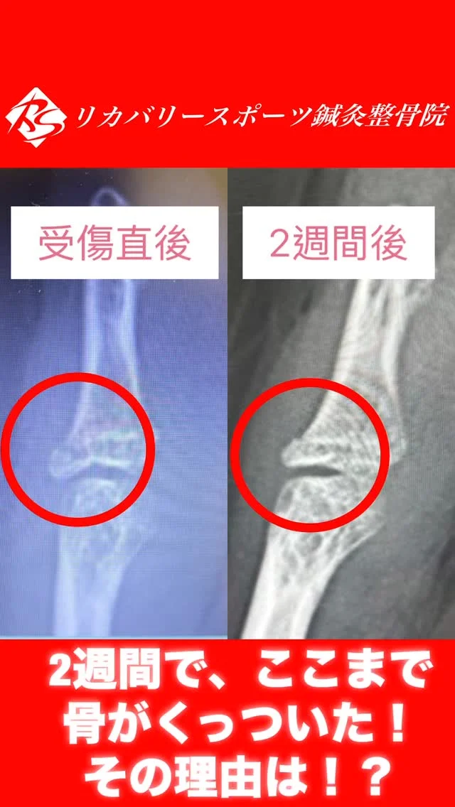 #超音波骨折治療器

骨折を1日でも早く治したい方にオススメなのが、超音波骨折治療器です！

超音波骨折治療器は、1日20分、出来るだけ毎日あてることで、約40%骨癒合を早めると言われています。

画像は、マレットフィンガーの骨癒合の促進のために、超音波骨折治療器をあてている様子です。

【受付時間】月・火・木・金　13:00〜21:00
　　　　　土・日・祝　　　10:00〜17:00
【休診日】　水曜日

🏥尼崎市南武庫之荘2丁目7-10
☎️06-6415-6477

#骨折の治療
#骨折を早く治す
#ケガ
#痛み
#違和感
#尼崎
#南武庫之荘
#塚口
#ケガを早く治す
#ケガの治療
#骨折
#骨折治療器
#捻挫
#肉離れ
#超音波骨折治療器
#超音波画像観察装置
#テーピング
#競技復帰
#競技復帰までトータルサポート
#競技復帰までのトレーニング
#リアラインスペシャリスト
#土日祝日診療してます