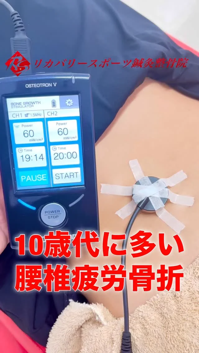 #腰椎疲労骨折

10歳代に多い『腰椎疲労骨折』
10歳代で、腰が痛い場合は要注意です⚠️

疲労骨折が、くっつかないままになってしまうと、『腰椎分離症』になり、一生骨が離れたままになってしまいます。
『腰椎疲労骨折』になってしまった場合は、辛いですがしばらくスポーツを休止しなくてはなりません😢
そんな辛い日を、1日でも短くするために、『超音波骨折治療器』がオススメです☝️

『超音波骨折治療器』は、骨がくっつく（癒合）を最大40%早めると言われています！

20分/日を、出来るだけ毎日当てることで効果が期待できます💪

リカバリースポーツ鍼灸整骨院では、1ヶ月使い放題のお得な価格設定になっています😊

お子様が、腰が痛い」と言ったら、すぐにご相談下さい！

【受付時間】月・火・木・金　13:00〜21:00
　　　　　土・日・祝　　　10:00〜17:00
【休診日】　水曜日

🏥尼崎市南武庫之荘2丁目7-10
☎️06-6415-6477

#腰痛
#子供の腰痛
#腰椎分離症
#腰が痛い
疲労骨折
骨折を早く治す
ケガ
痛み
違和感
尼崎
南武庫之荘
塚口
ケガを早く治す
ケガの治療
骨折
骨折治療器
捻挫
肉離れ
超音波骨折治療器
超音波画像観察装置
テーピング
競技復帰
競技復帰までトータルサポート
競技復帰までのトレーニング
リアラインスペシャリスト
土日祝日診療してます
